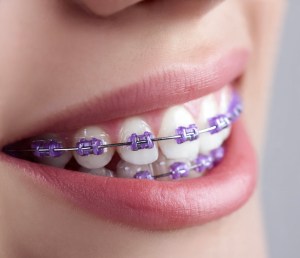 close up purple braces elastics on teeth showing purple braces color option