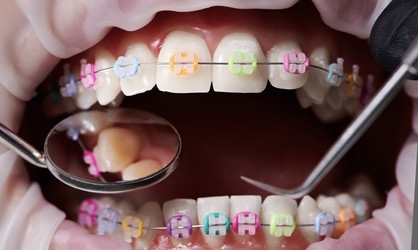 close up of colorful braces elastic showing multiple braces color options