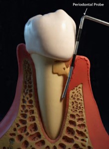 Dental Hygienist using a periodontal probe to measure gum pocket depth for deep cleaning assessment.
