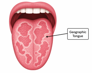 Close up graphic of a geographic tongue