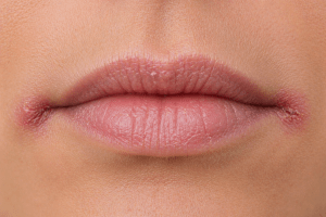 A close up image of angular cheilitis