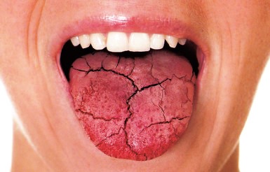 A tongue up close showing that dry mouth affects the tongue