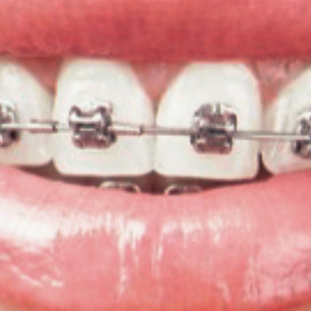 Braces image close up