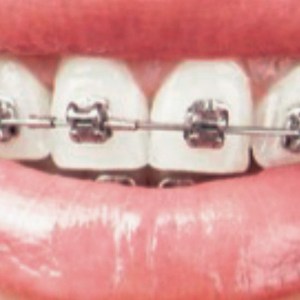 Braces image close up